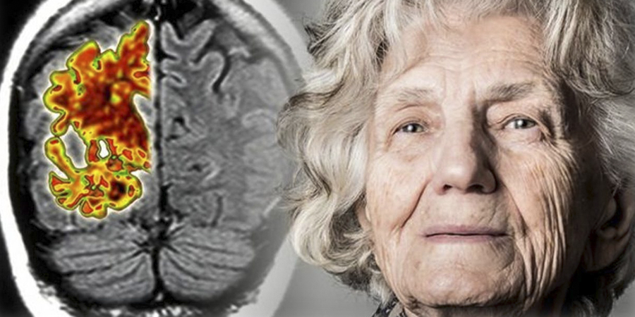 Отличие болезни Альцгеймера от деменции у пожилых