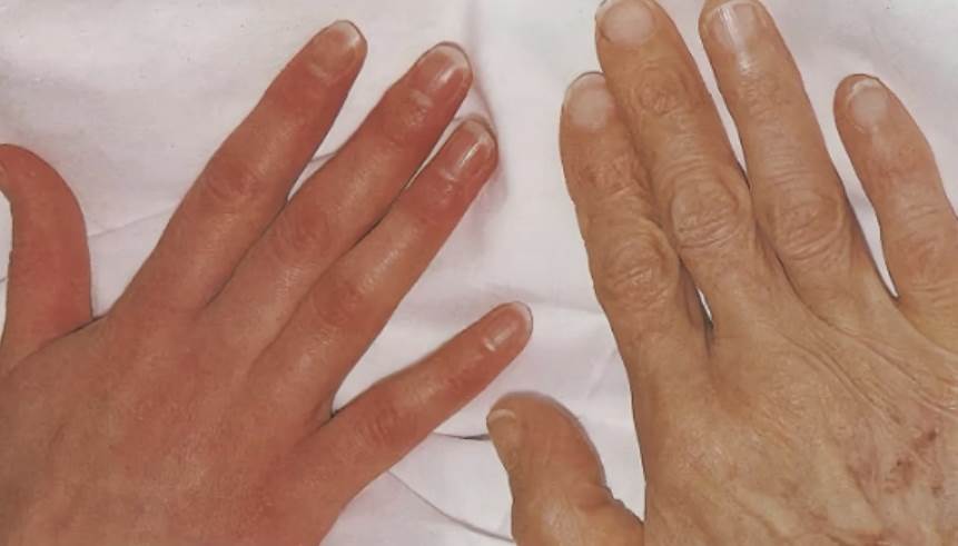 Симптомы анемии на руках пожилых