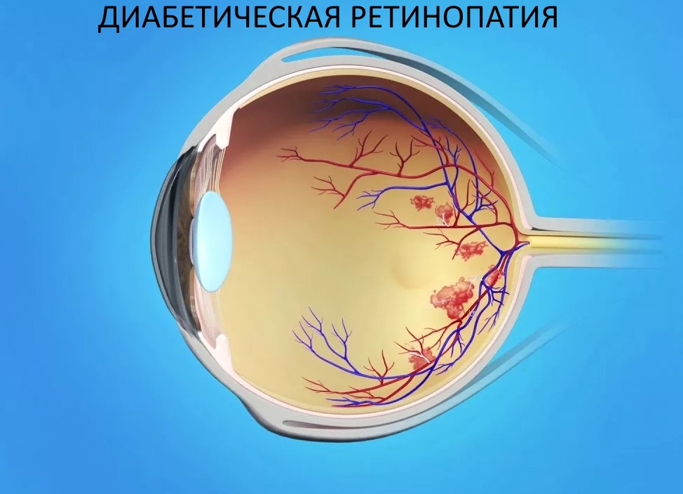 Диабетическая ретинопатия.jpg