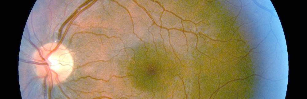 Диабетическая ретинопатия у пожилых