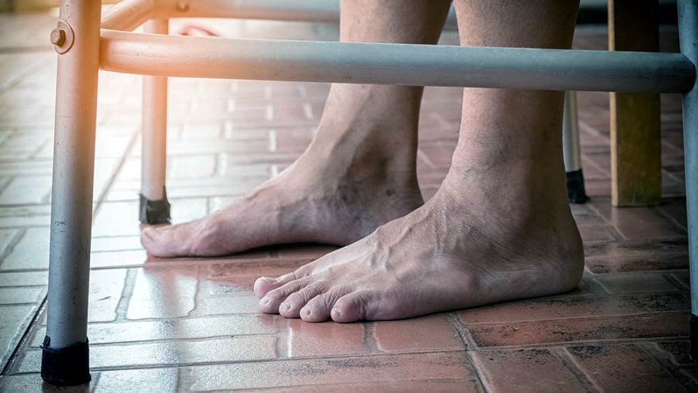 Слабость в ногах у пожилых людей: причины, лечение, профилактика