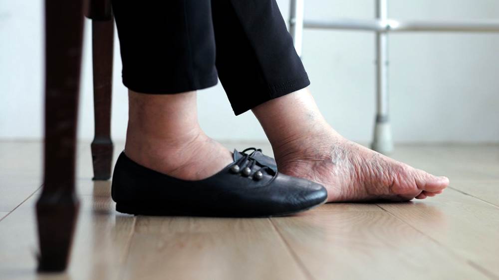 Отеки ног у пожилых из-за неудобной обуви