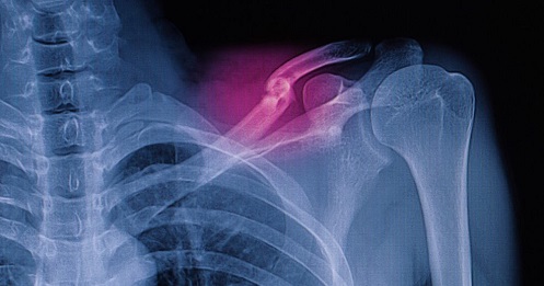 Симптомы и последствия травмы плеча